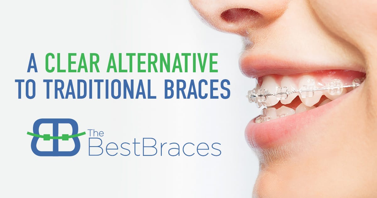 A Clear Alternative to Traditional Braces