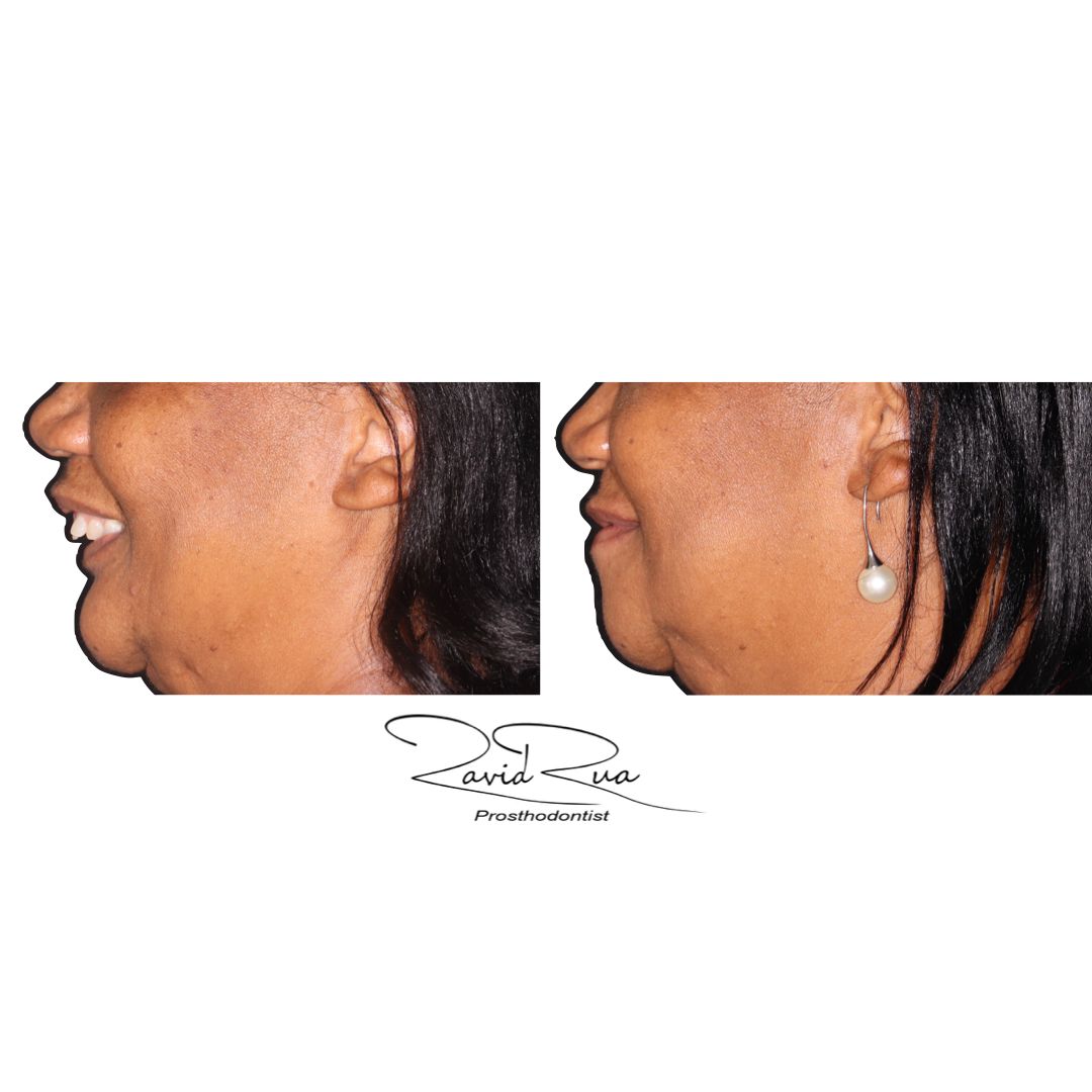 TC Cape Coral Case 10 Rib graft and All on 4 Segmental Hybrid for a cancer survival patient