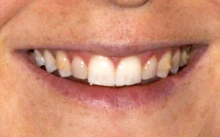15. Patient KG (10 teeth)_ Porcelain veneers on upper 10 teeth Before