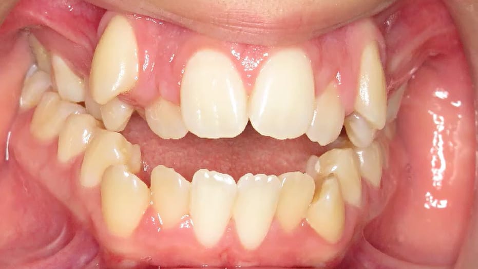 BF Ortho Smile Gallery Before