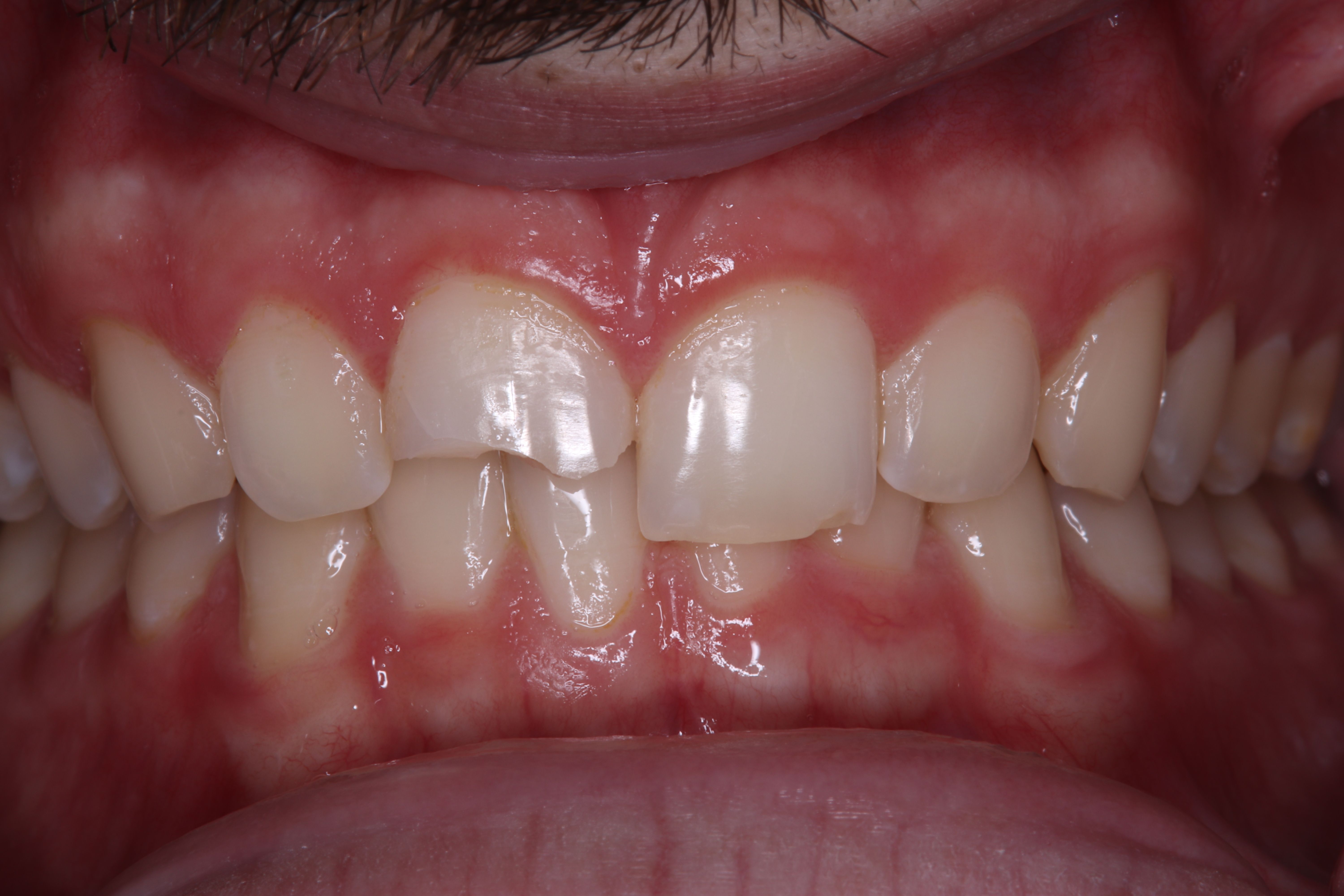 Rasner Smile gallery before 1