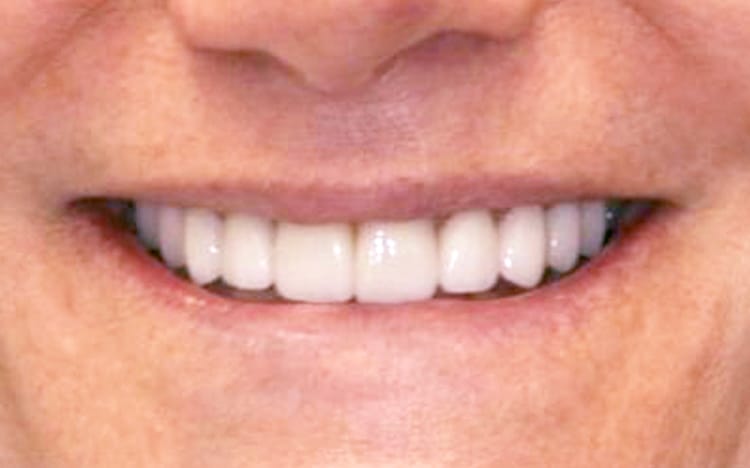 19. Patient MC (10 teeth)_ Mix of porcelain veneers and crowns on upper 10 teeth After