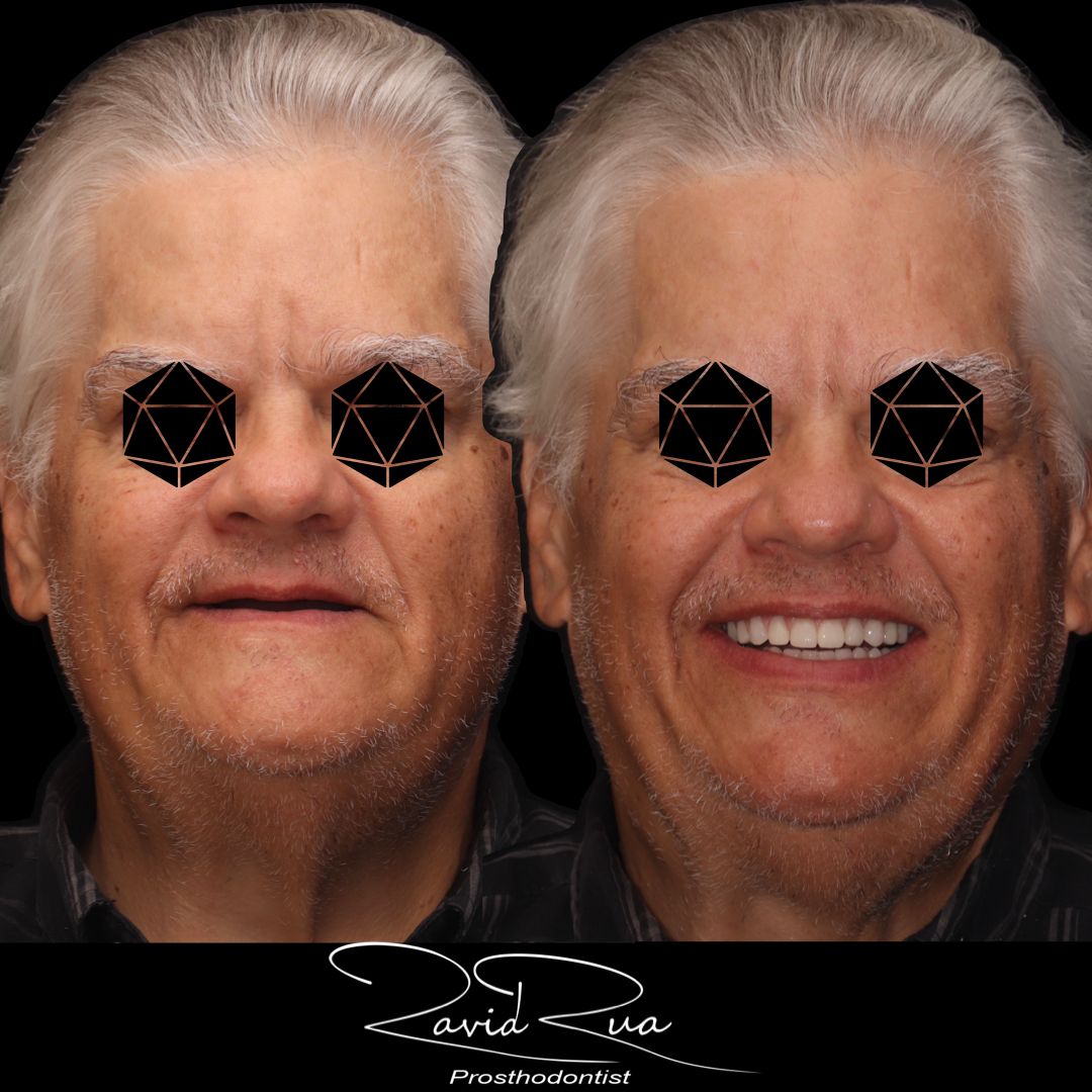 TC Cape Coral Case 7 All on 5 implant hybrid and bottom telescopic  restoration
