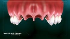 Implant-Supported Bridge 005
