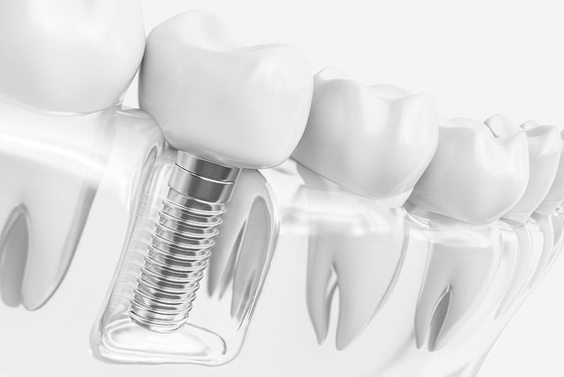 Single Dental Implant Single Dental Implant