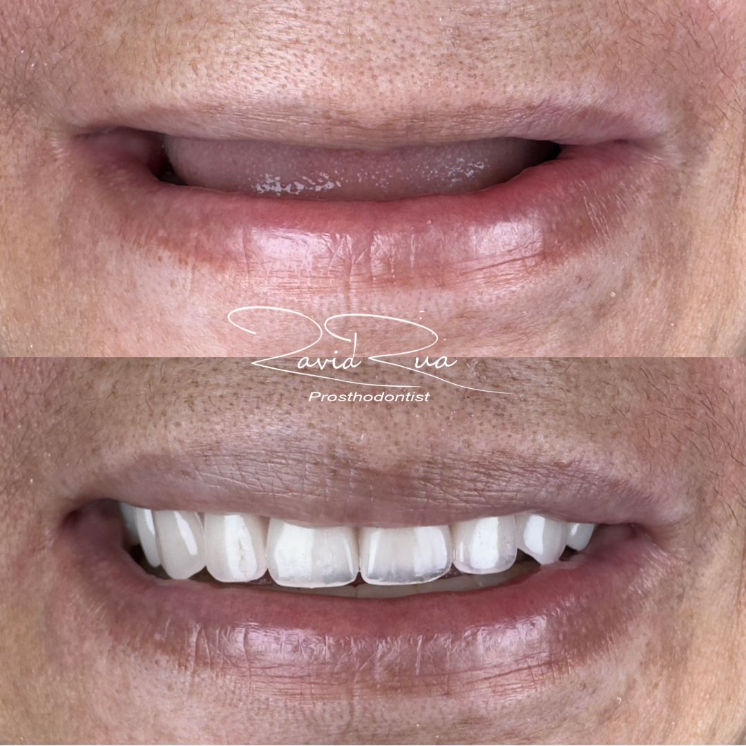 TC Cape Coral Case 23 Overdenture on 4 implants in a patient with Facial Paralysis