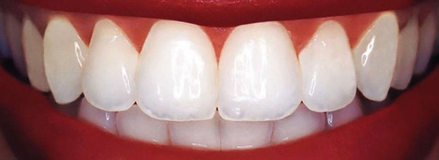 Dental Bonding
