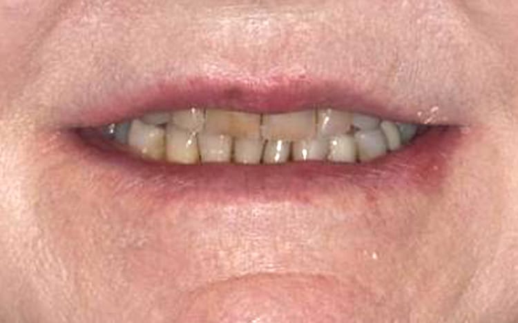 24. Patient ED (18 teeth + 3 implants)_ 8 upper porcelain crowns with 4 porcelain crowns on lower back teeth with and implant supported bridge for lower front 6 teeth Before