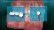 Bridge Versus An Implant 001