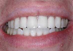 ballston smile gallery case-13-after
