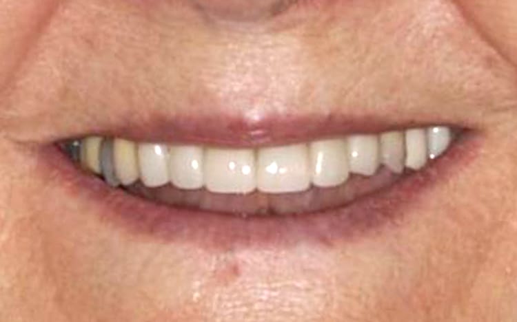 10. Patient CS (6 teeth)_ 6 porcelain crowns on front teeth After