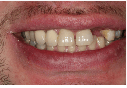 Veneers before