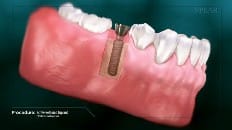 Screw-Retained Implant 003