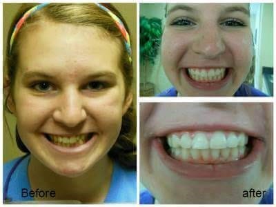 Before and after