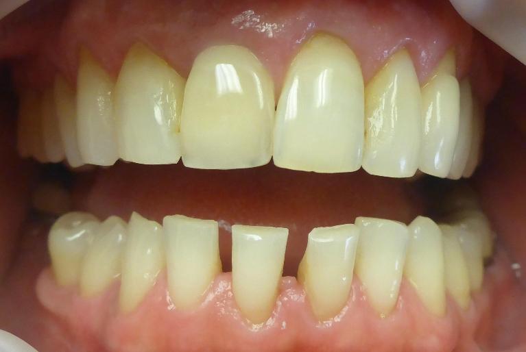 Grapevine Before Veneers Bottom