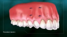 Apicoectomy image 005
