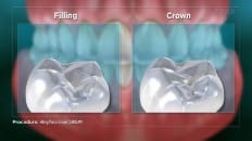 Filling Versus Crown 007 image