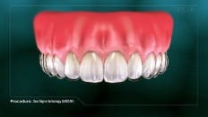 Clear Aligner Technology image 005