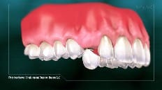 Single Implant (Anterior - Healing Cap) 004