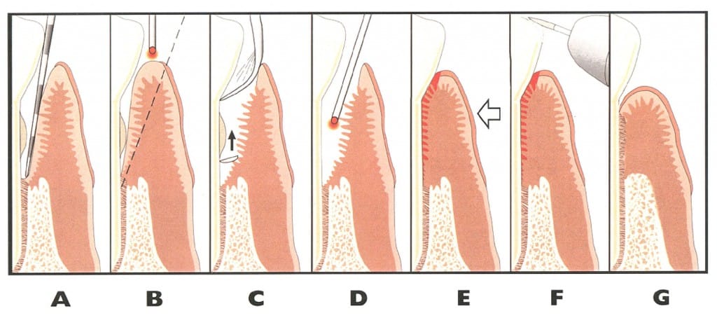 Laser Periodontal Therapy Steps