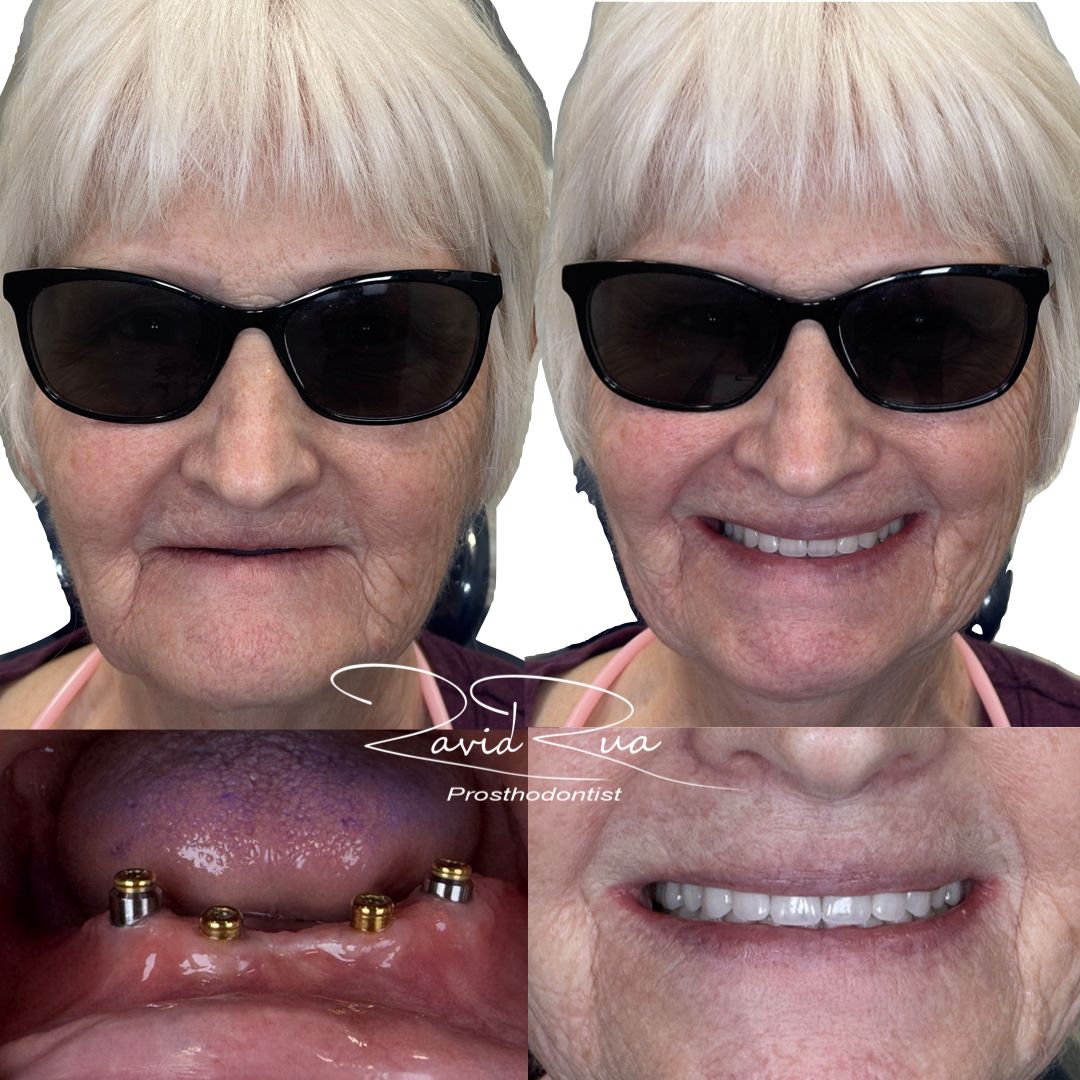 TC Cape Coral Case 4  Top denture and bottom implant overdenture