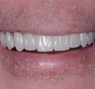 Dental Implants After
