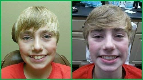 Before and after