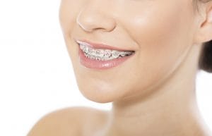 braces