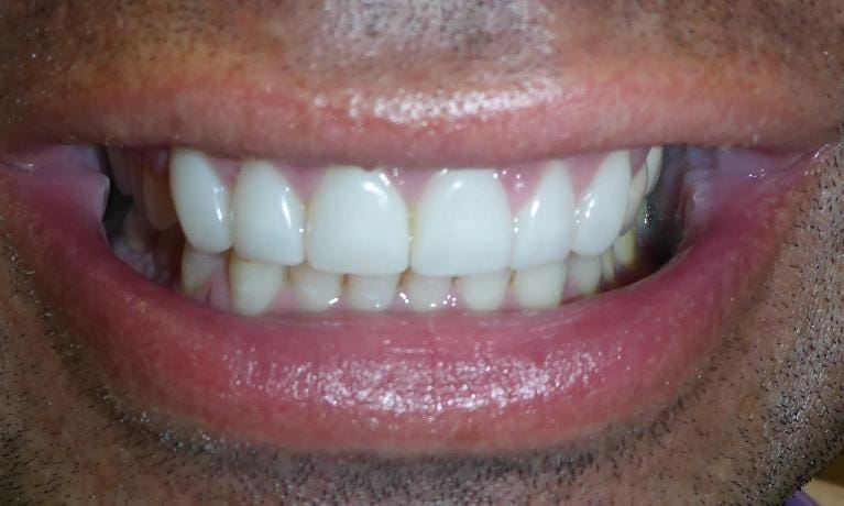Grapevine After Cosmetic Dentistry 2