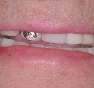 Dental Implants Before