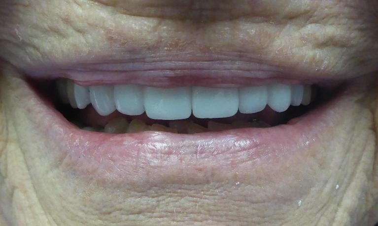 Grapevine After Smile Transformation 2