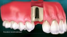 Bone Graft With Immediate Implant Placement 003