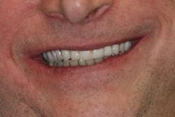 Same Day Permanent Dentures after