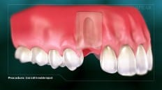 Bone Graft With Immediate Implant Placement 002