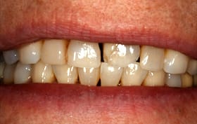 Smile Gallery - before