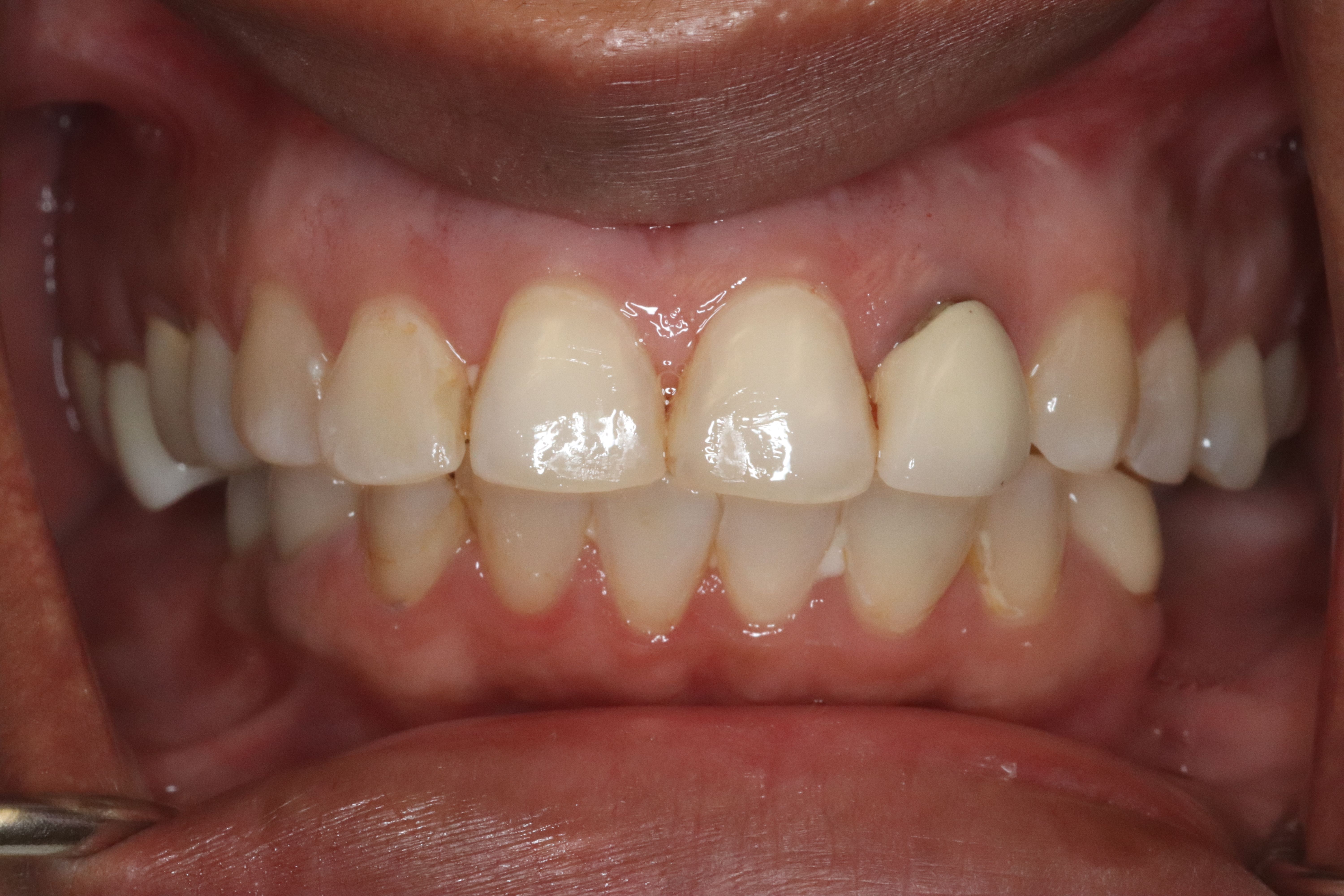 Rasner Smile gallery before 3
