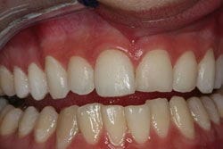 Veneers before