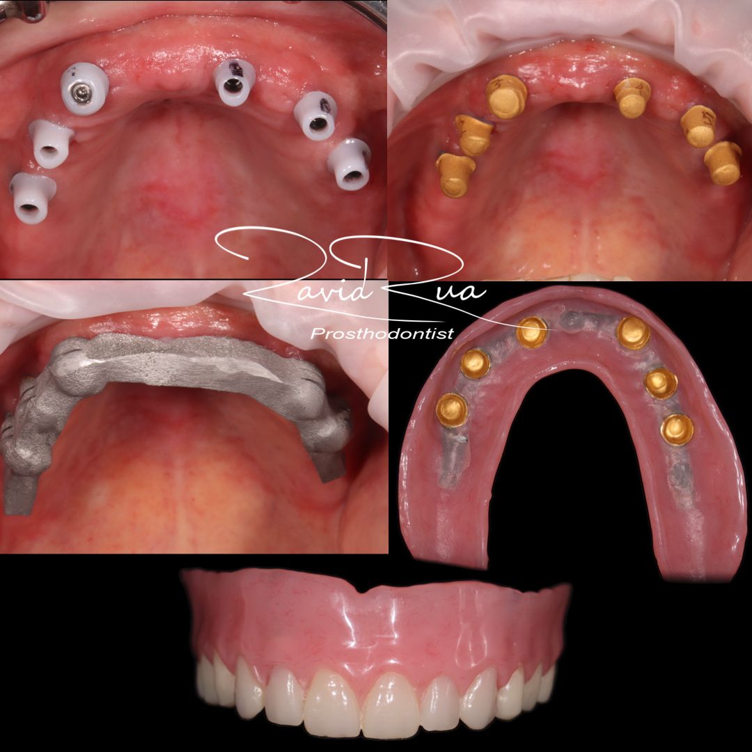 TC Cape Coral Case 21.1 Top telescopic restoration