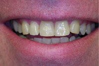 Zoom Whitening before