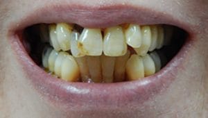Dental Implants Before