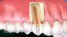 Root Canal image 003