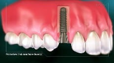 Single Implant (Anterior - Healing Cap) 003