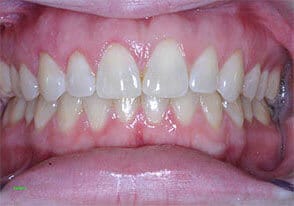 ballston smile gallery case-1-after