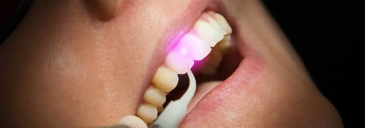 Laser Gum Therapy