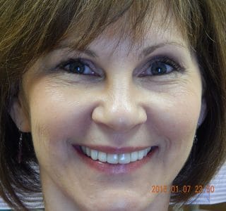 Porcelain Veneers Before