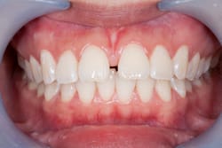 LIVING WITH YOUR SENSITIVE TEETH