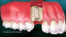 Bone Graft With Immediate Implant Placement 004