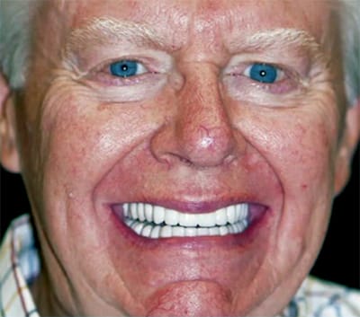 Dental Implants After