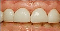 Before and After