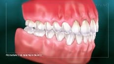 Single Implant (Anterior - Healing Cap) 007